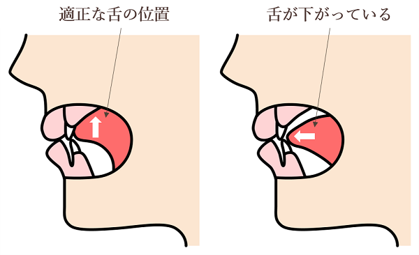 口呼吸