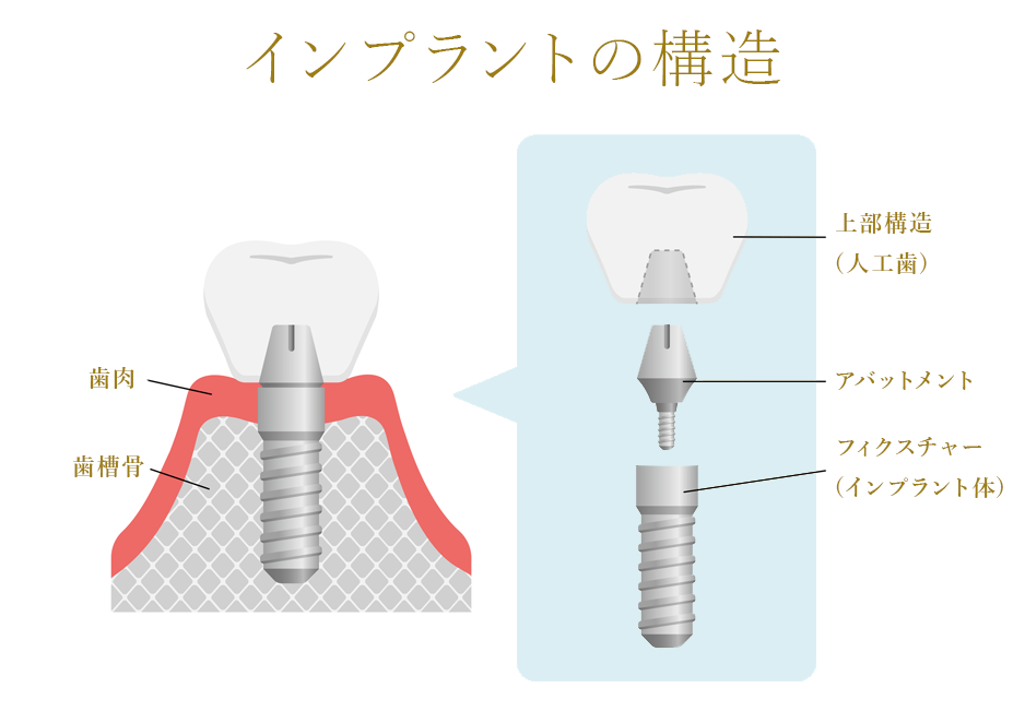 インプラントとは？