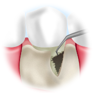 歯根表面の清掃