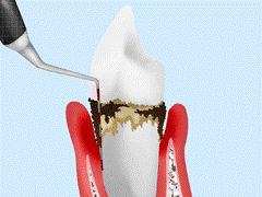 歯周組織の検査
