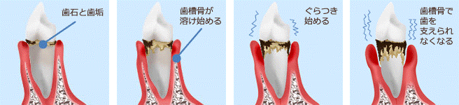 歯周病とは